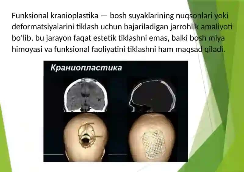 Funktsional kranioplastika 3