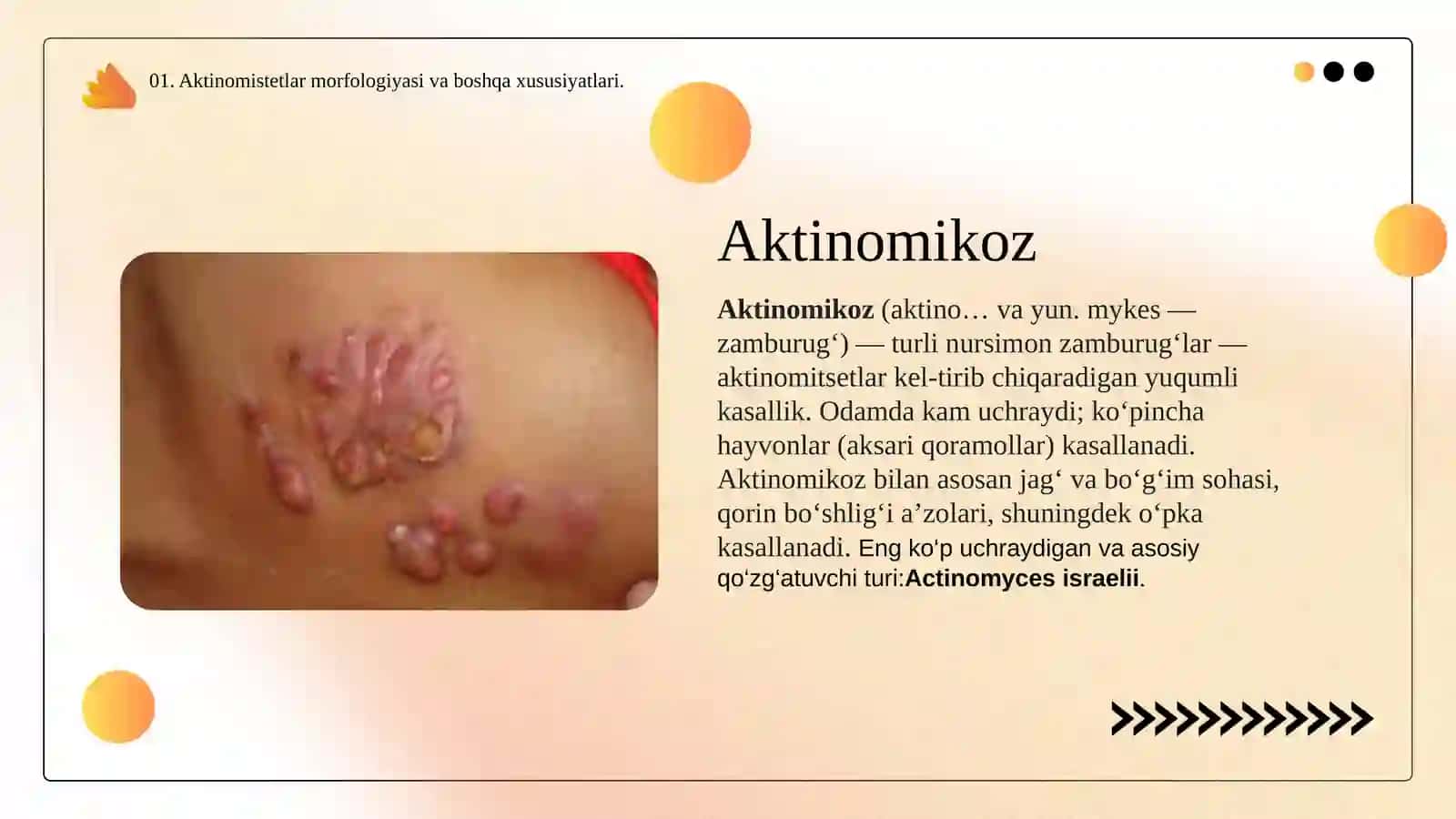 Aktinomikoz 3