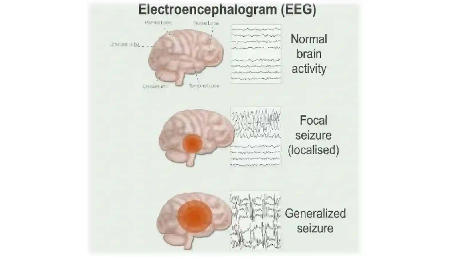 Epilepsiya 3