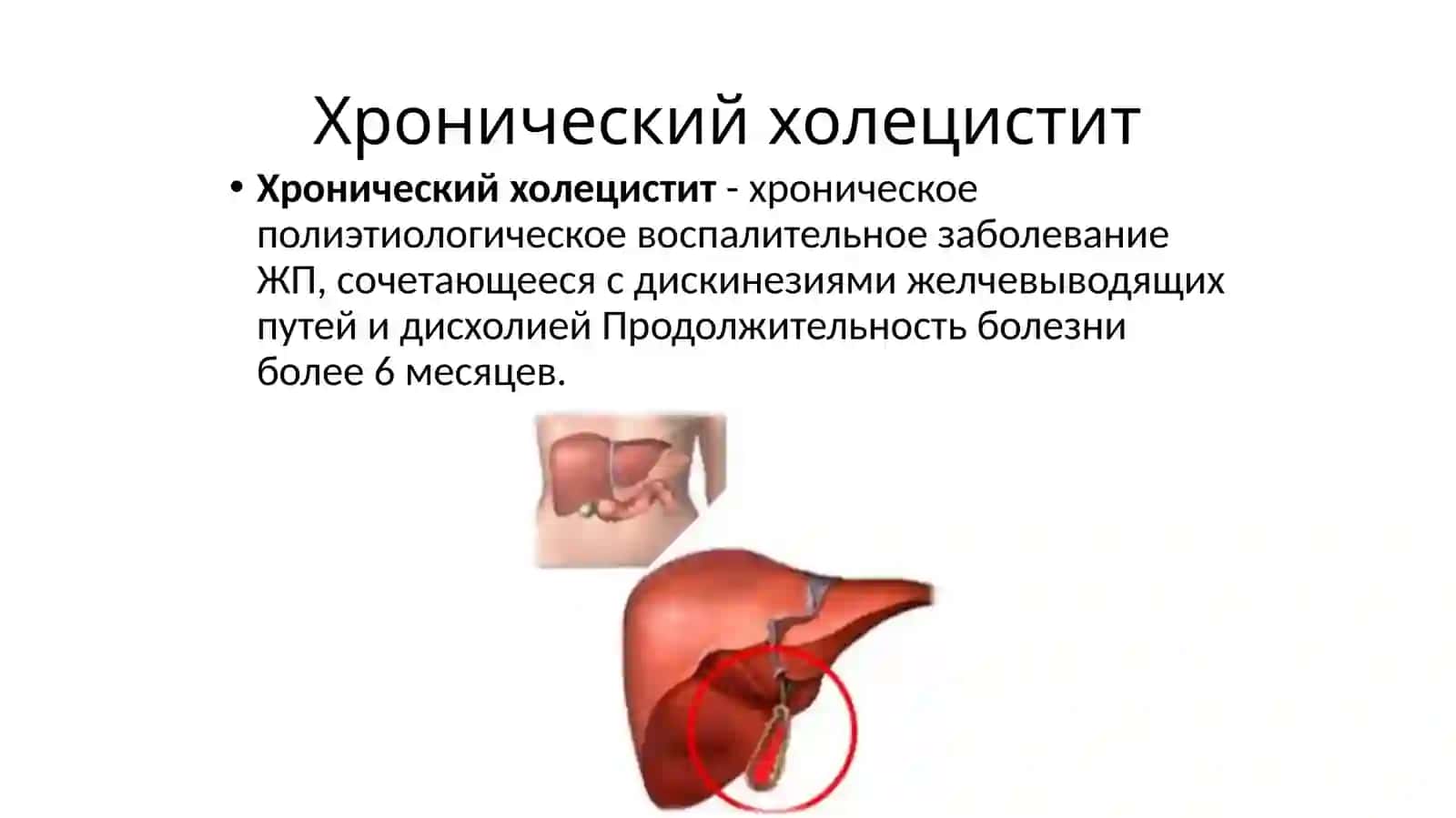 Хронический холецистит 3