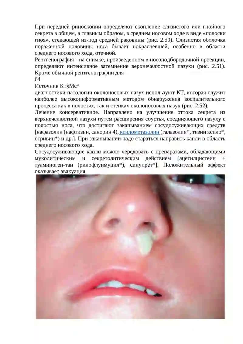 Заболевания околоносовых пазух 3