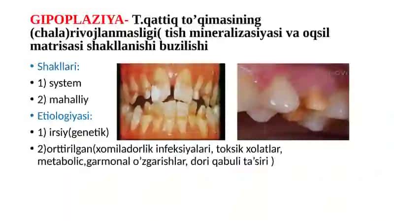 TISHLARNING NOKARIYES KASALLIKLARI 3