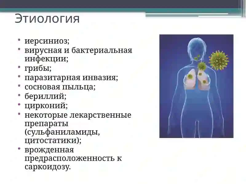 Саркоидоз легких 3