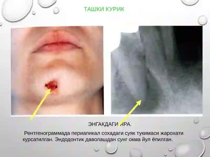 Perkussiya turlari. Patologik periodontal chontakning chuqurligini aniqlash. Tishlarning patalogik harakatchanligi, uning darajalari. 3