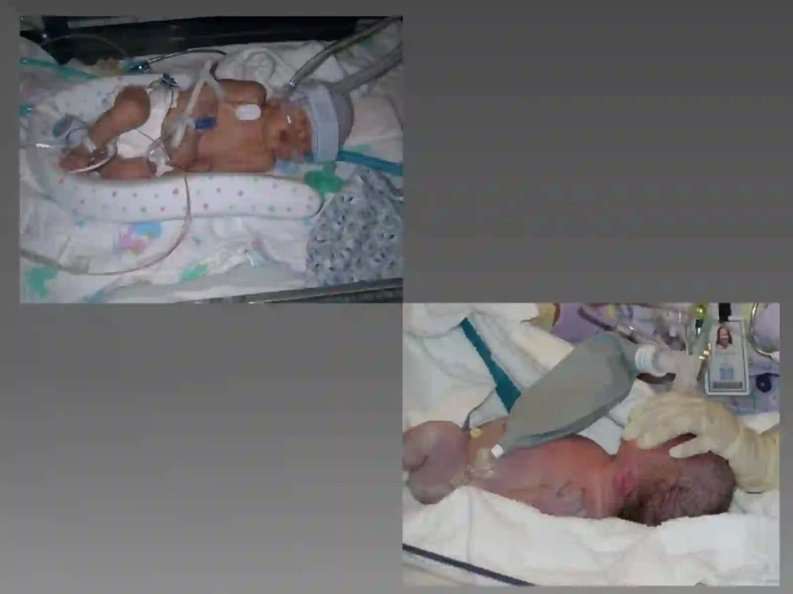 YANGI TUG’ILGAN CHAQALOQLAR ASFIKSIYASI 3