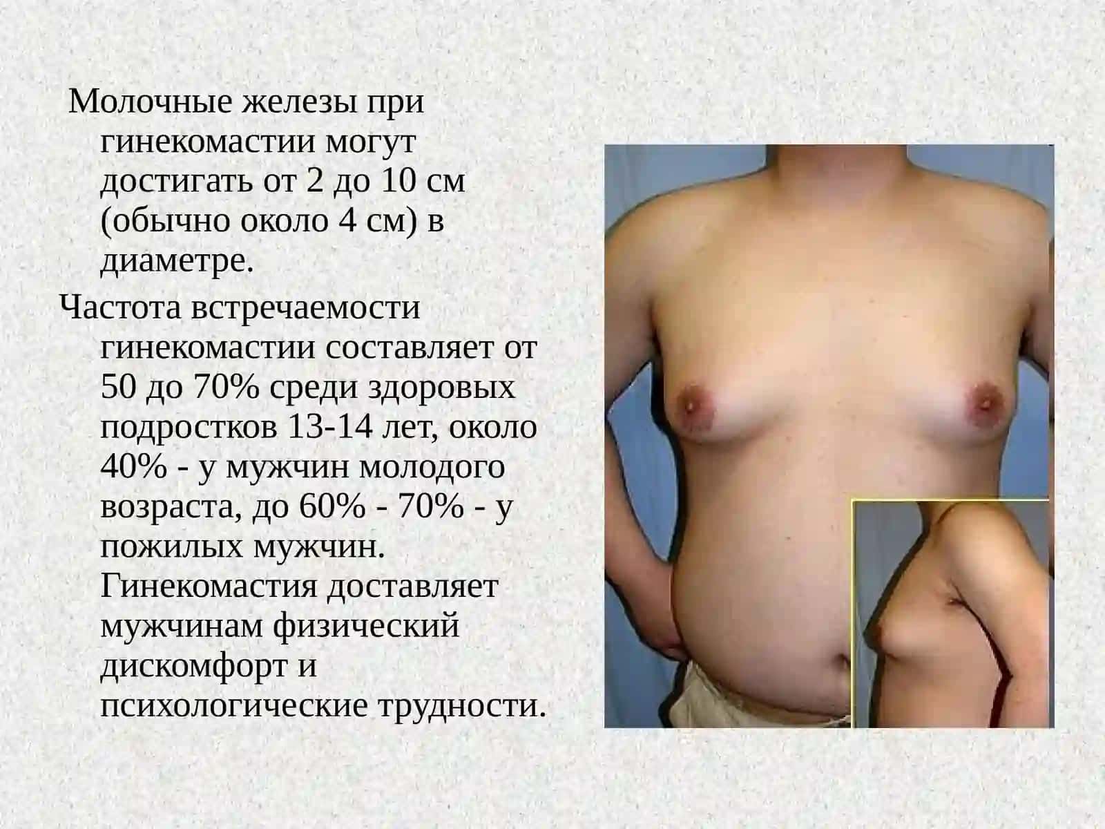 Гинекомастия 3