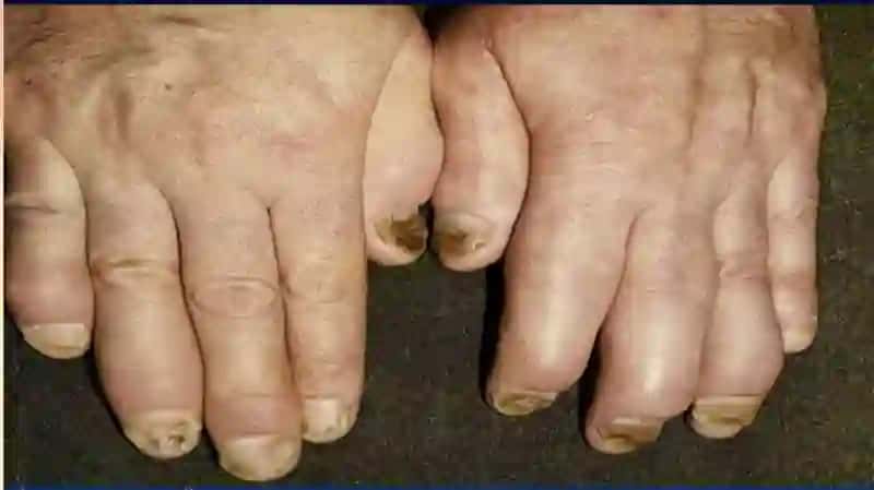 Psoriaz (Psoriasis) – nima? 3