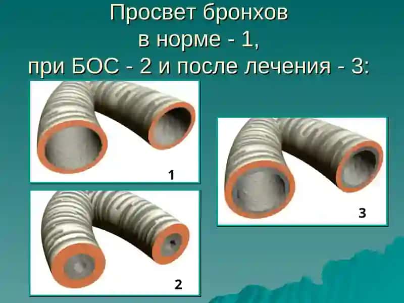 Тема лекции: Синдром бронхообструкции 3