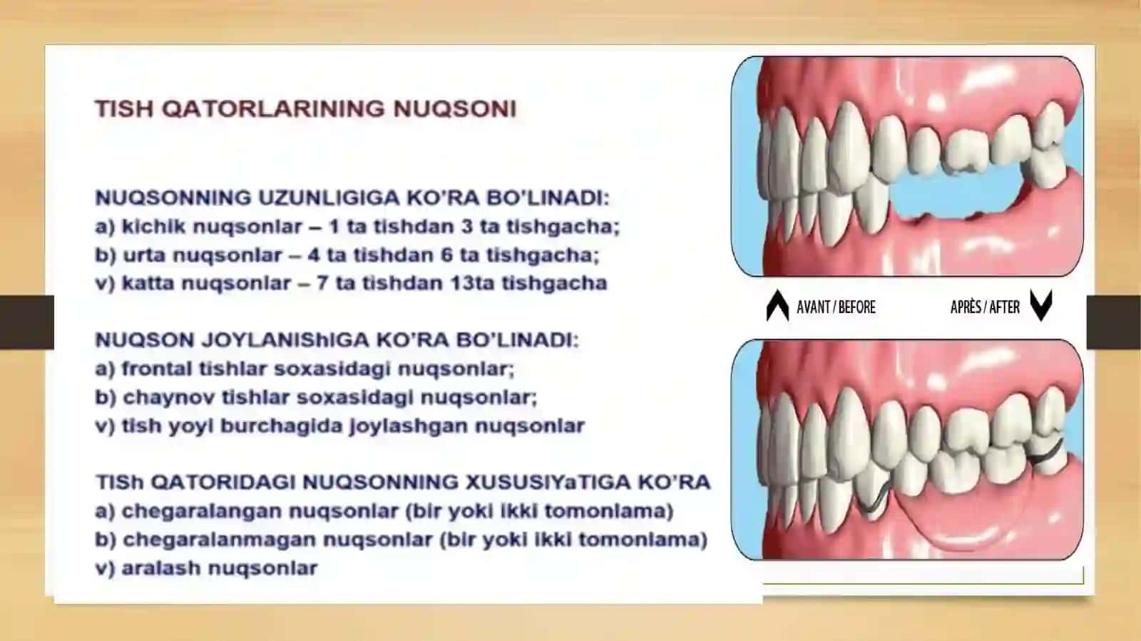 Tish qatorlari qisman nuqsonlari 3