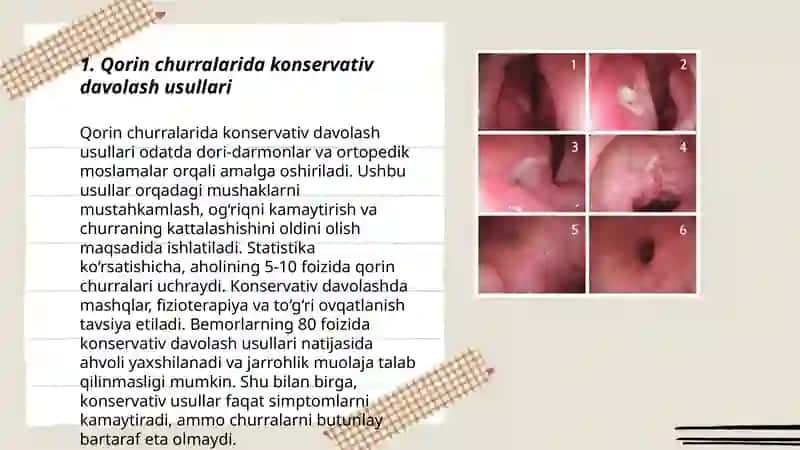 Qorin churralarida davolash usullari. 12 barmoq ichak yara kasalligi profilaktikasi va davolash 3