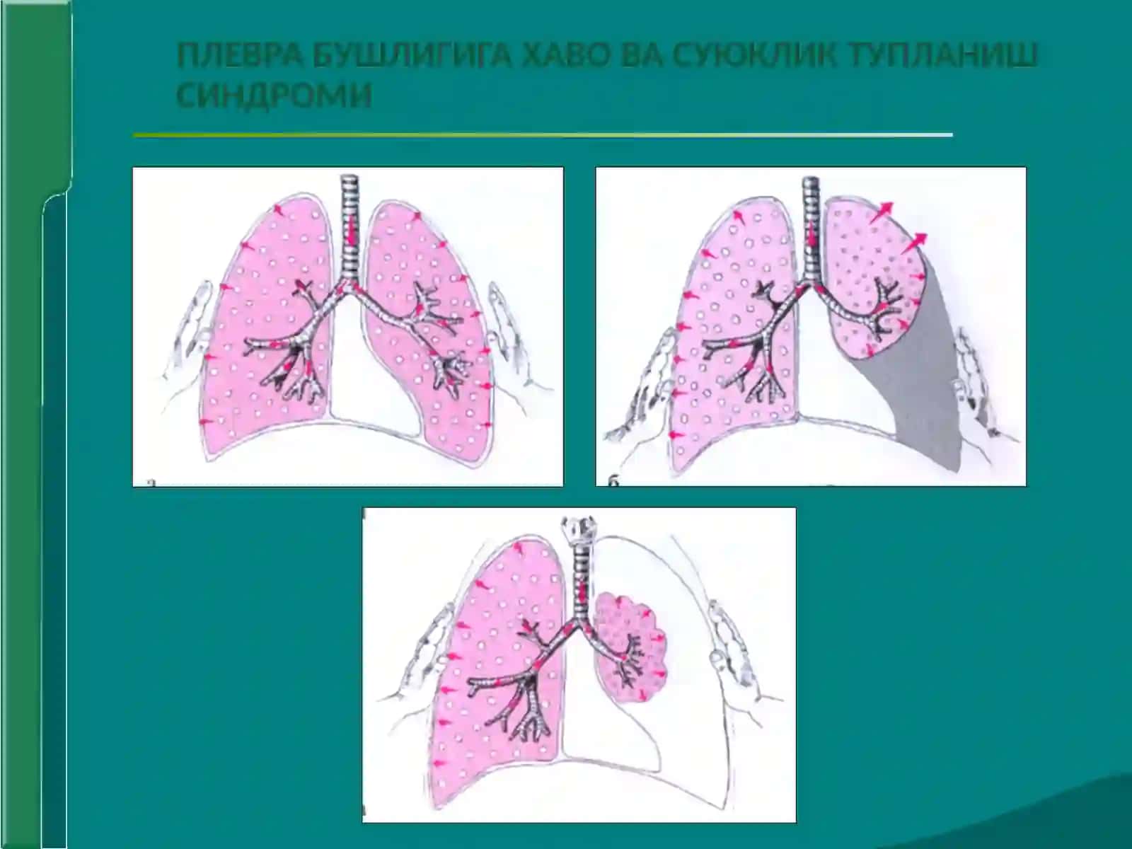 Plevra bo‘shlig‘ida havo va suyuqlik to‘planish sindromi 3