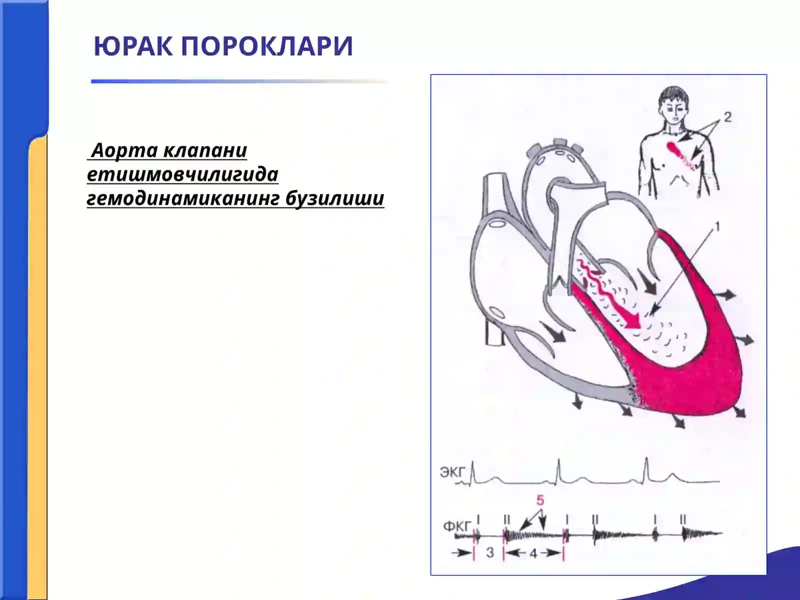 ЮРАК ПОРОКЛАРИ. АОРТА КЛАПАНИНИНГ ЕТИШМОВЧИЛИГИ.АОРТА ОҒЗИНИНГ СТЕНОЗИ.ҚОН АЙЛАНИШИ ЕТИШМОВЧИЛИГИ 3