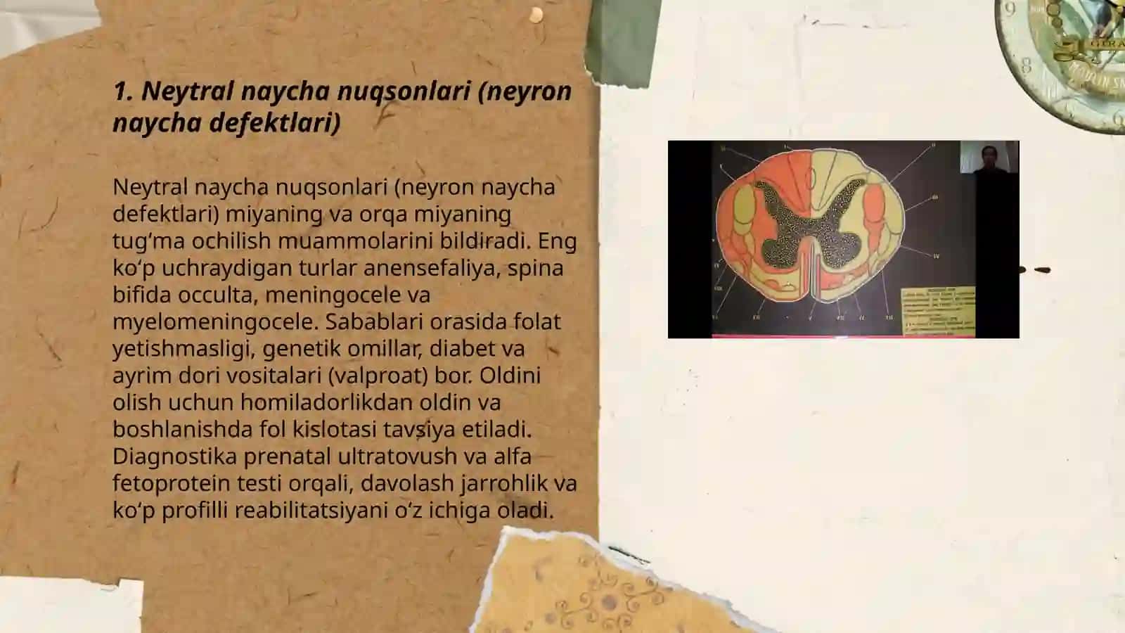 Neytral naycha nuqsonlari (neyron naycha defektlari) 3