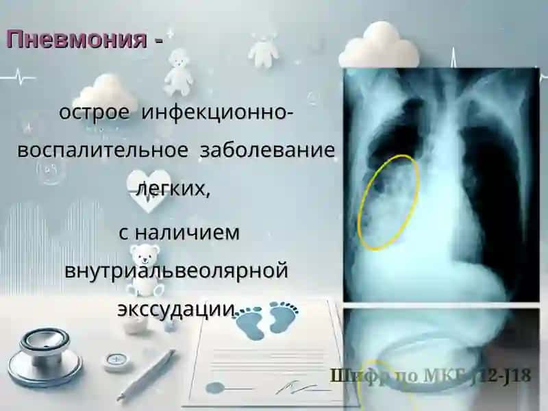 Пневмония у детей 3