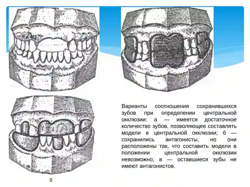 Марказий окклюзияни аниқлаш асослари ва сунъий тишларни териш асослари 3