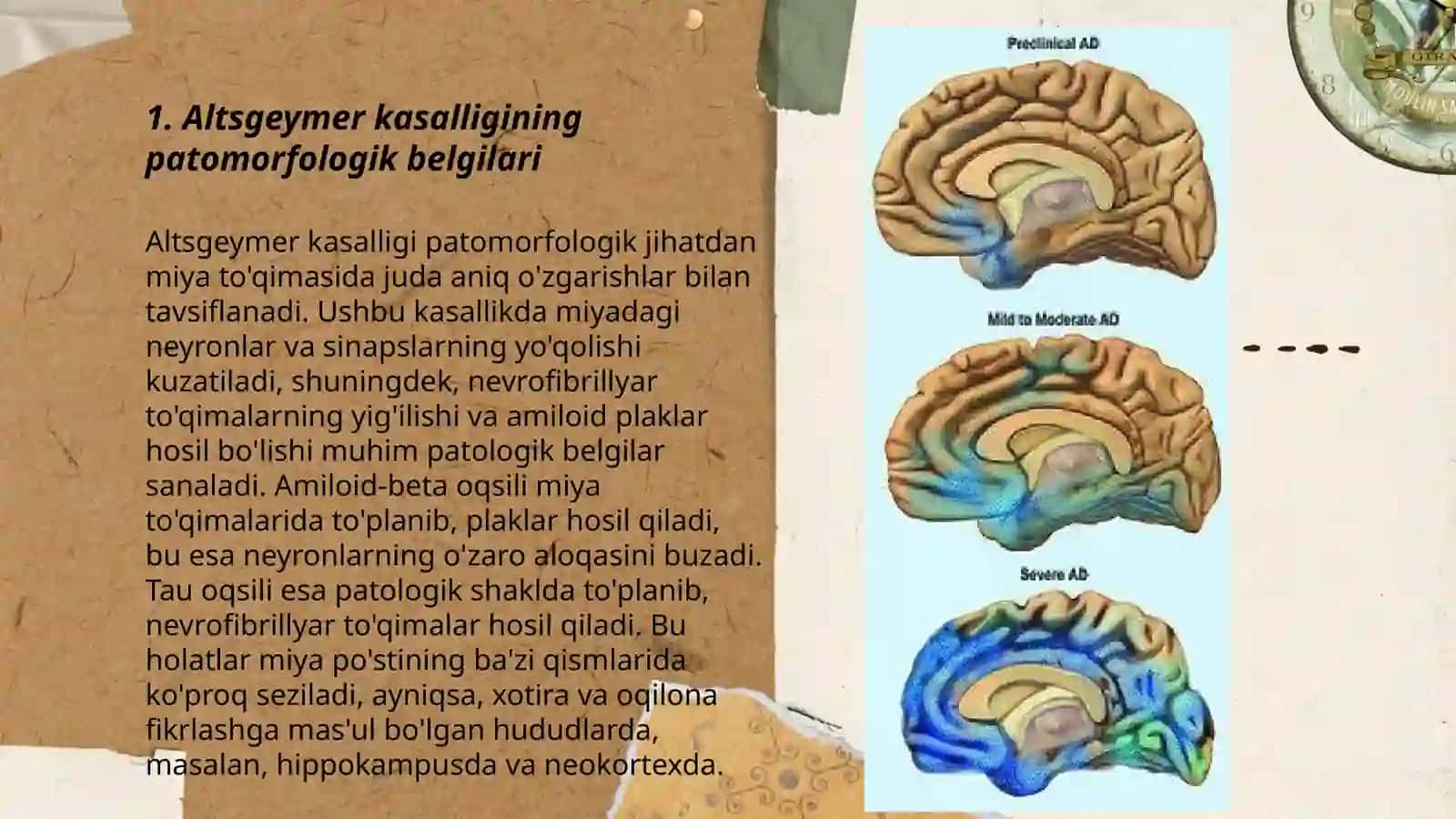 Alstgeymer kasalligi patalogik anatomiyasi va patomorfozi 3
