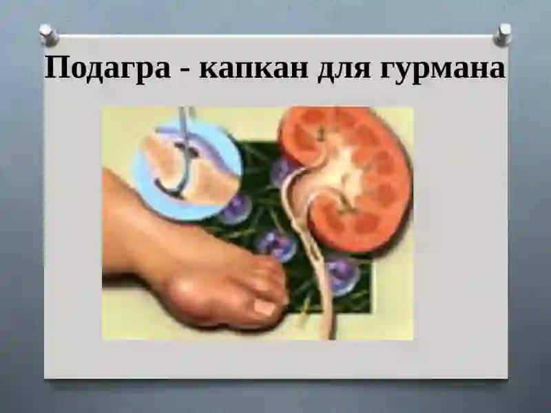 ПОДАГРА 3
