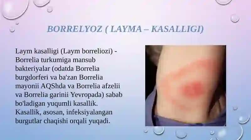Borrelyoz (Layma-kasalligi) 3