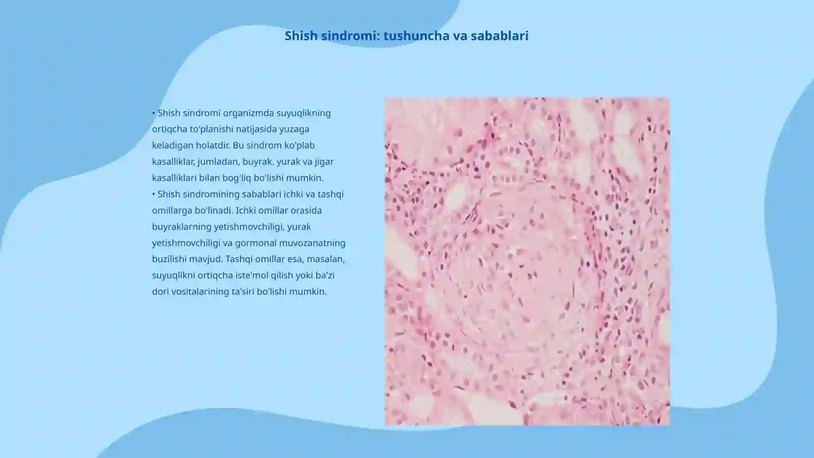 Shish sindromi bilan kechuvchi kassalliklar. Glomerulonefrit davolash, tashxisot mezonlari, dispanser kuzatuvi, profilaktik 3