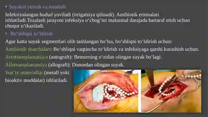 OSTEOMIYELITDA BAJARILADIGAN OPERATSIYA 3