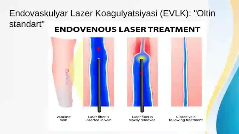 Oyoq venalari varikoz kasalligida bajariladigan operatsiyalar 3