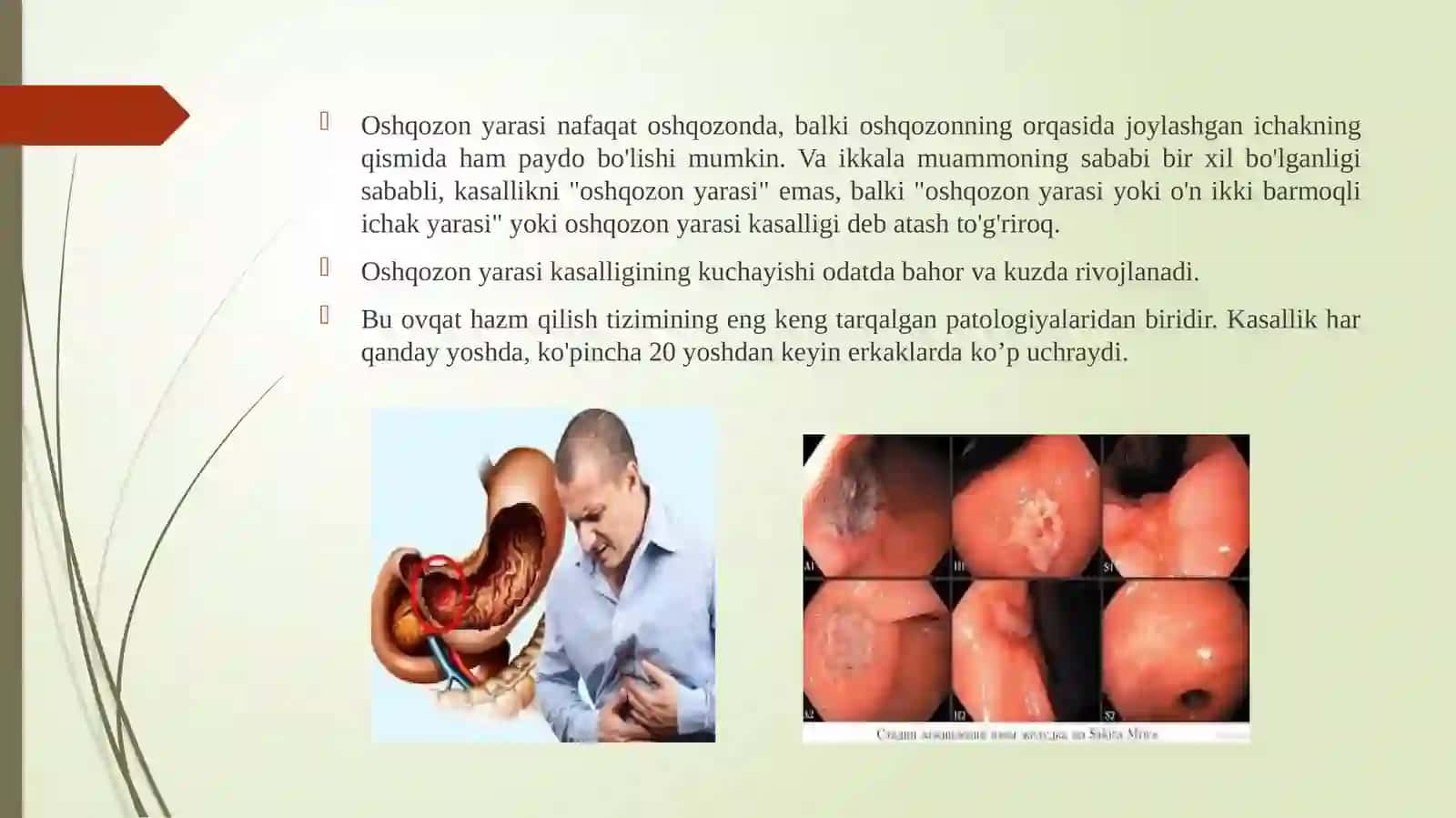 Oshqozon ichak yarasi kasalligining 1,2, va 3 lamchi profilaktikasi 3