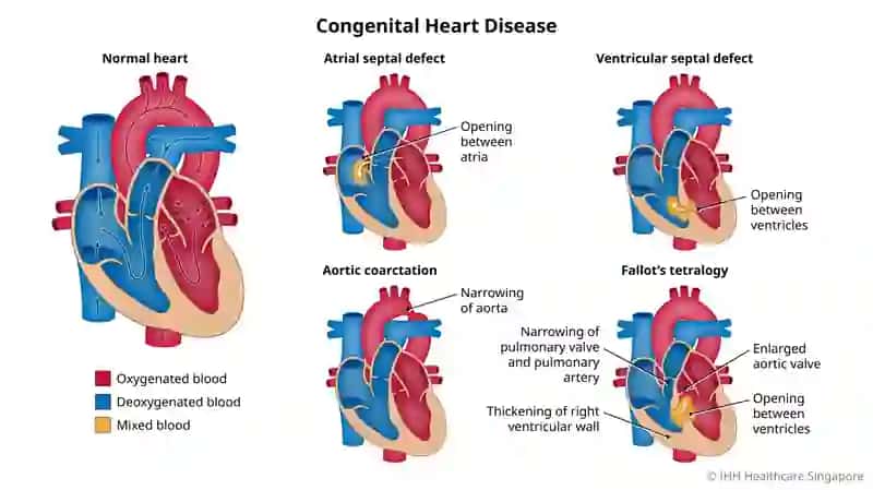 Yurak nuqsonlarining revmatizm, infeksion endokardit va aorta aterosklerozi kasalliklarida rivojlanish sabablari. EKG va rentgenologik tekshiruvdagi belgilari va davolash usullari. Aortal yurak nuqsonlarining etiologiyasi, patogenezi, klinikasi va diagnostikasi 3