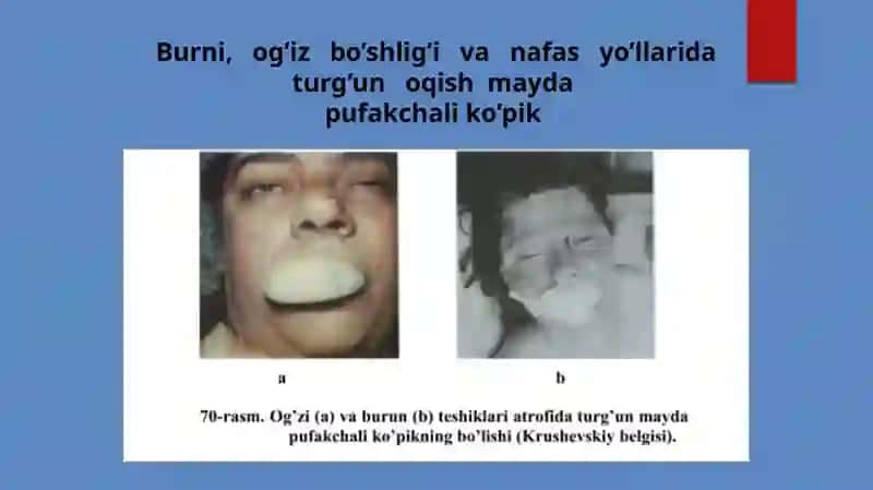 CHO‘KISHDA LABORATORIYA TEKSHIRUVI USULLARI2-davolash 407-bguruhYòldoshevaXadicha 3