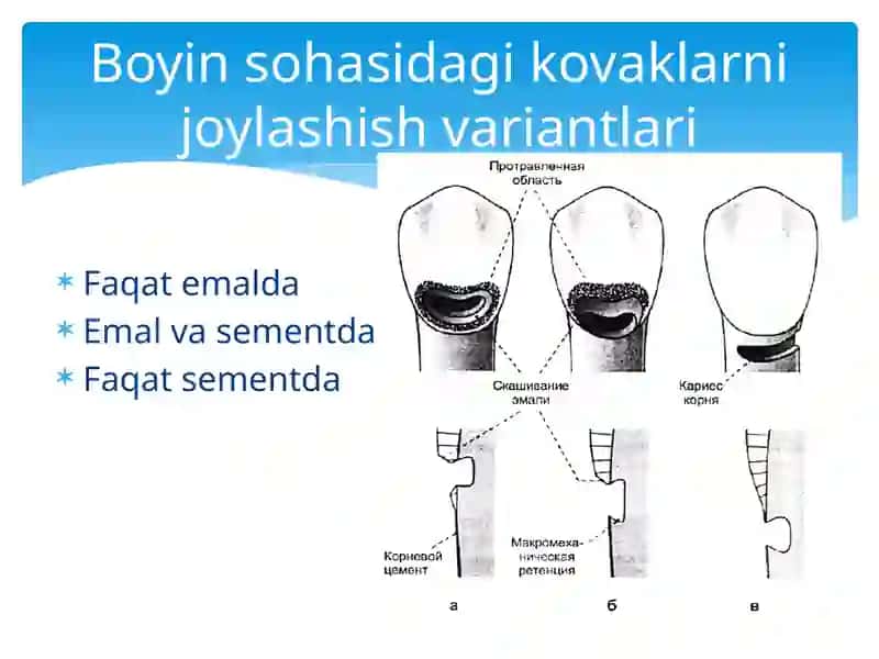 Blek bo‘yicha V sinfli karies kovaklarini restavratsiya qilishning klinik tamoyillari. 3