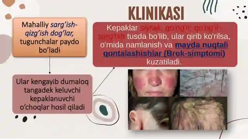 Seboreyali dermatit 3