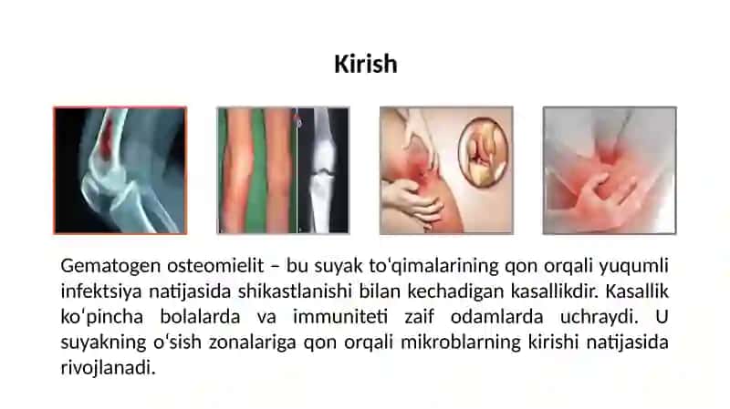 Gematogen osteomiyelit mustaqil ish  . tibbiyot 3