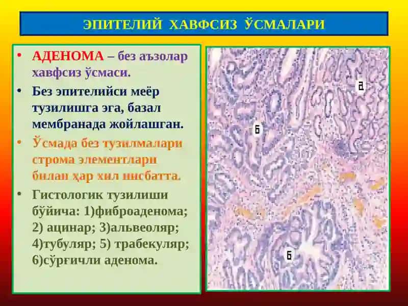 Ўсмалар. Мезенхимал ўсмалар 3