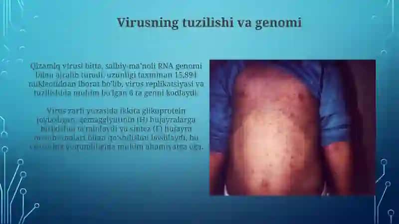 Qizamiq virusi: immunosupressiya mexanizmi va klinikasi 3