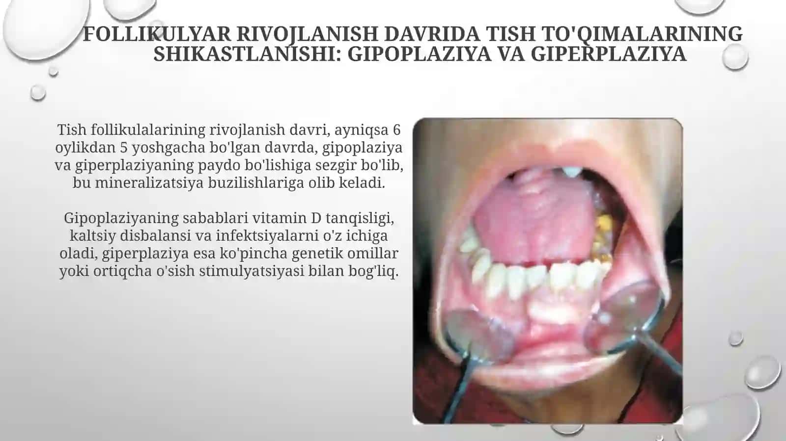 Tish to'qimalarining shikastlanishi: Gipoplaziya va Giperplaziya 3
