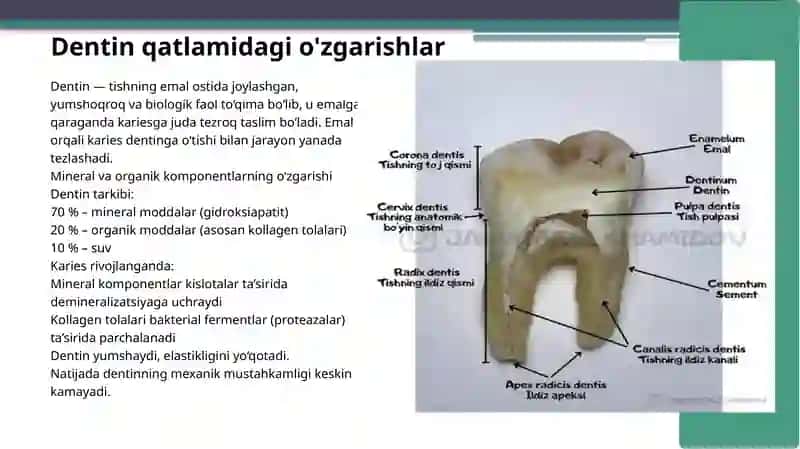 Kariesning patologika anatomiyasi 3