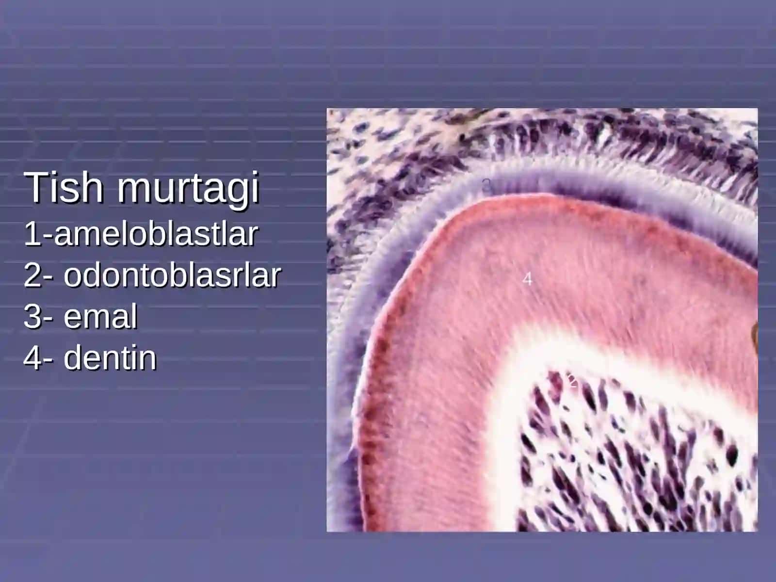 Emalning oʻtkir o'choqli demineralizatsiyasi 3