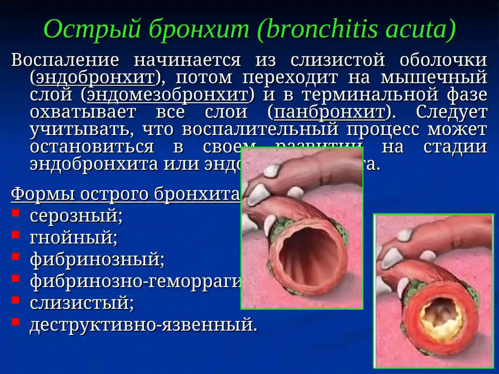 Острый бронхит (bronchitis acuta) 3