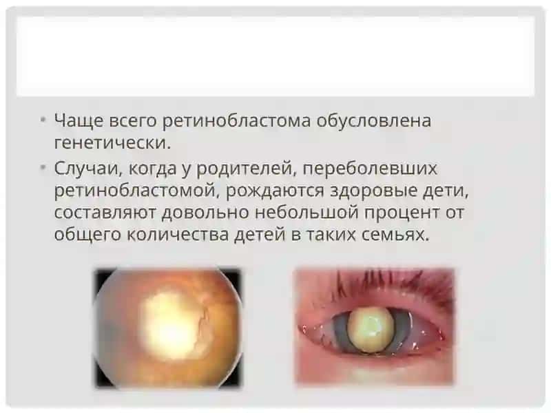 Ретинобластома 3
