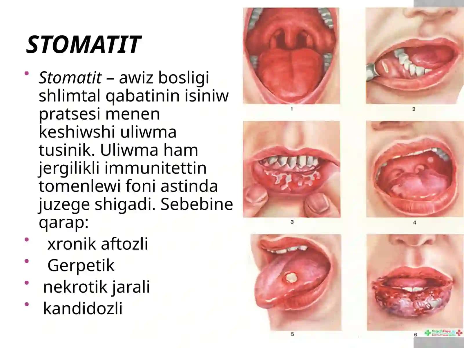 Stomatit 3