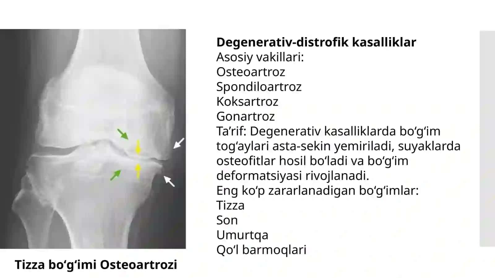 Boʻgimlarni distrofik degenerativ kasalliklari 3