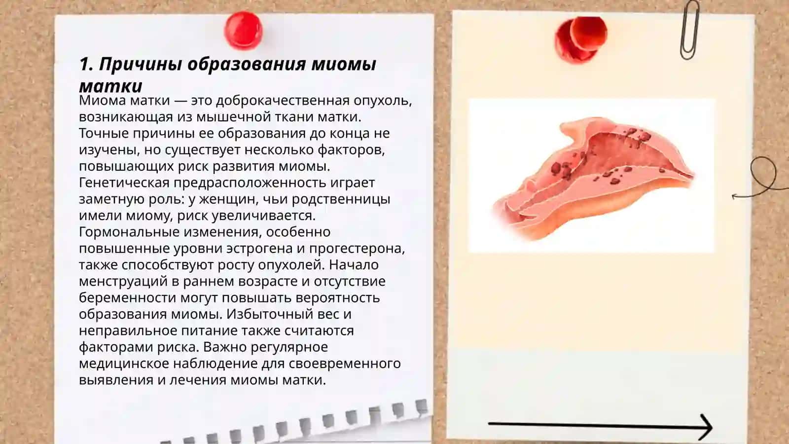 Миома матки 3