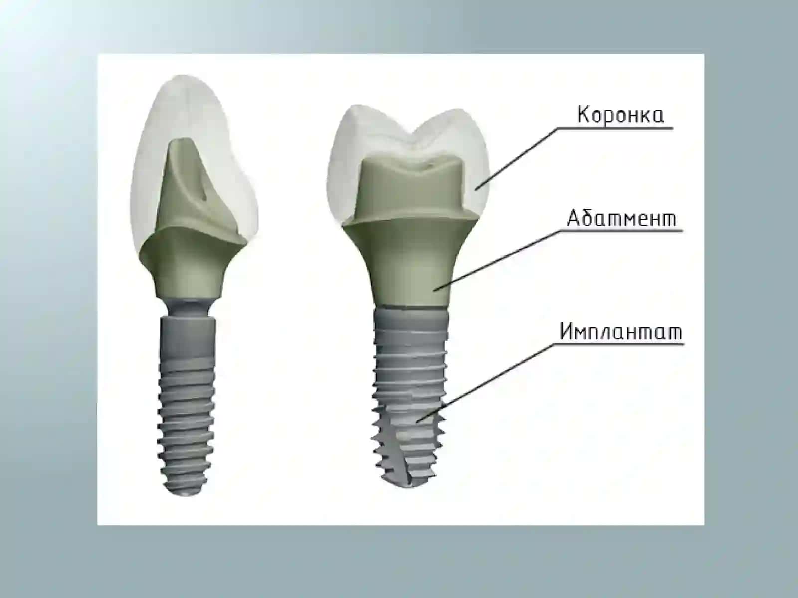 Implant asosidagi protezlar 3