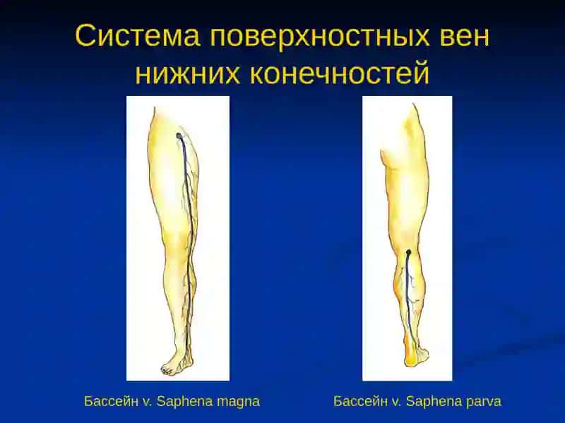Заболевания вен нижних конечностей 3