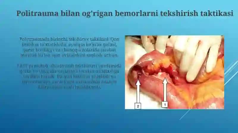 Ko’krak qafasi, qorin bo’shlig’i va kichik tos azolari travmasi. Politravmada tekshirish taktikasi 3
