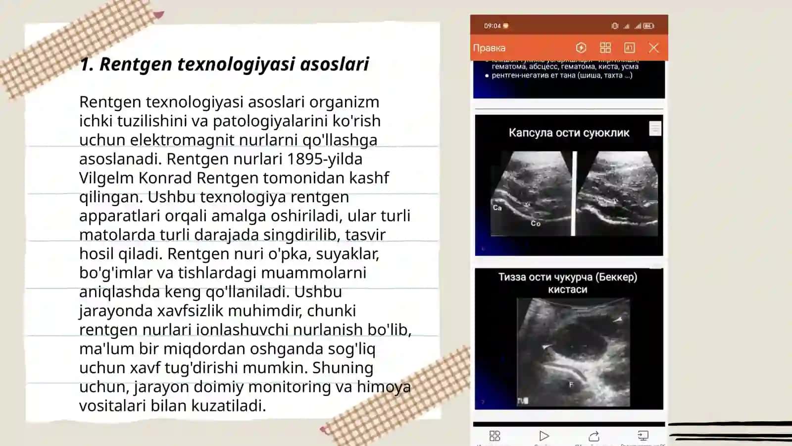Xavsiz o'smalar rentgeni 3