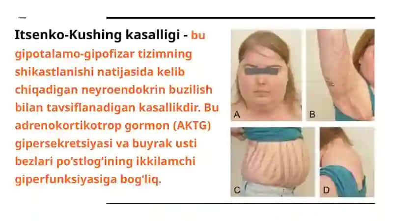 Itsenko-Kushing kasalligi va Sindromi 3