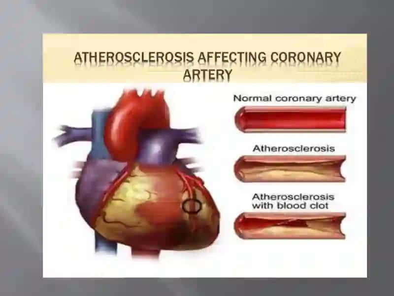 Atherosclerosis 3