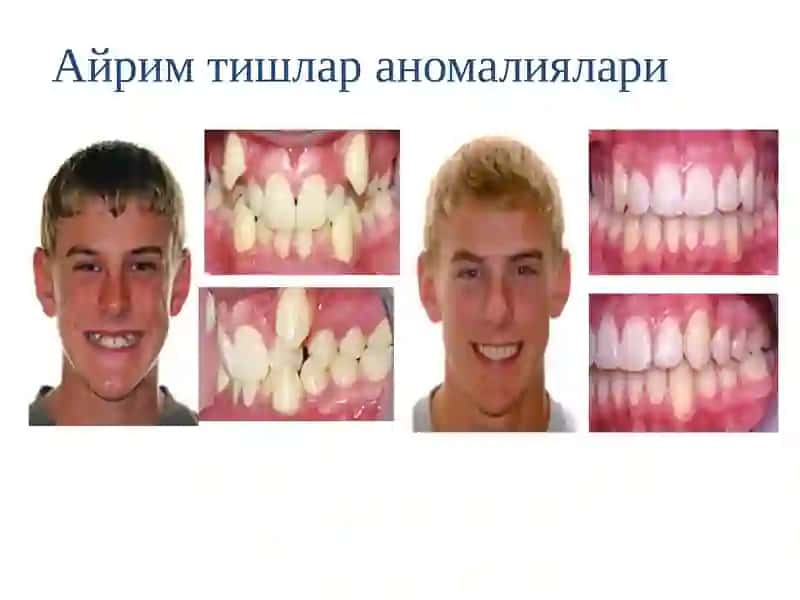 Тишлардаги аномалиялар 3