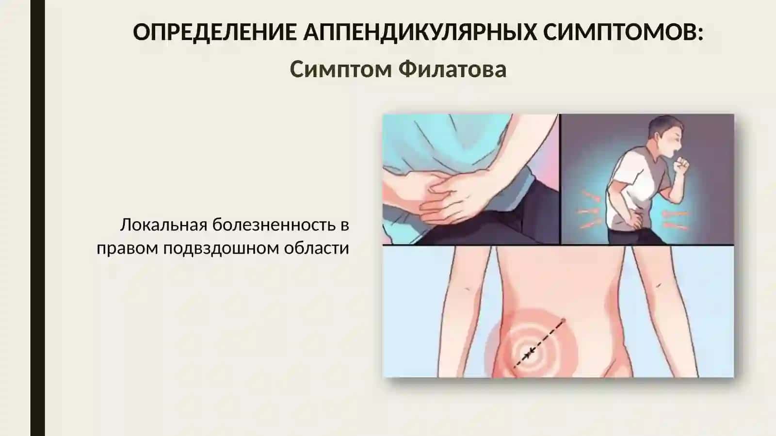 Ректальное исследование при тазовом аппендиците 3