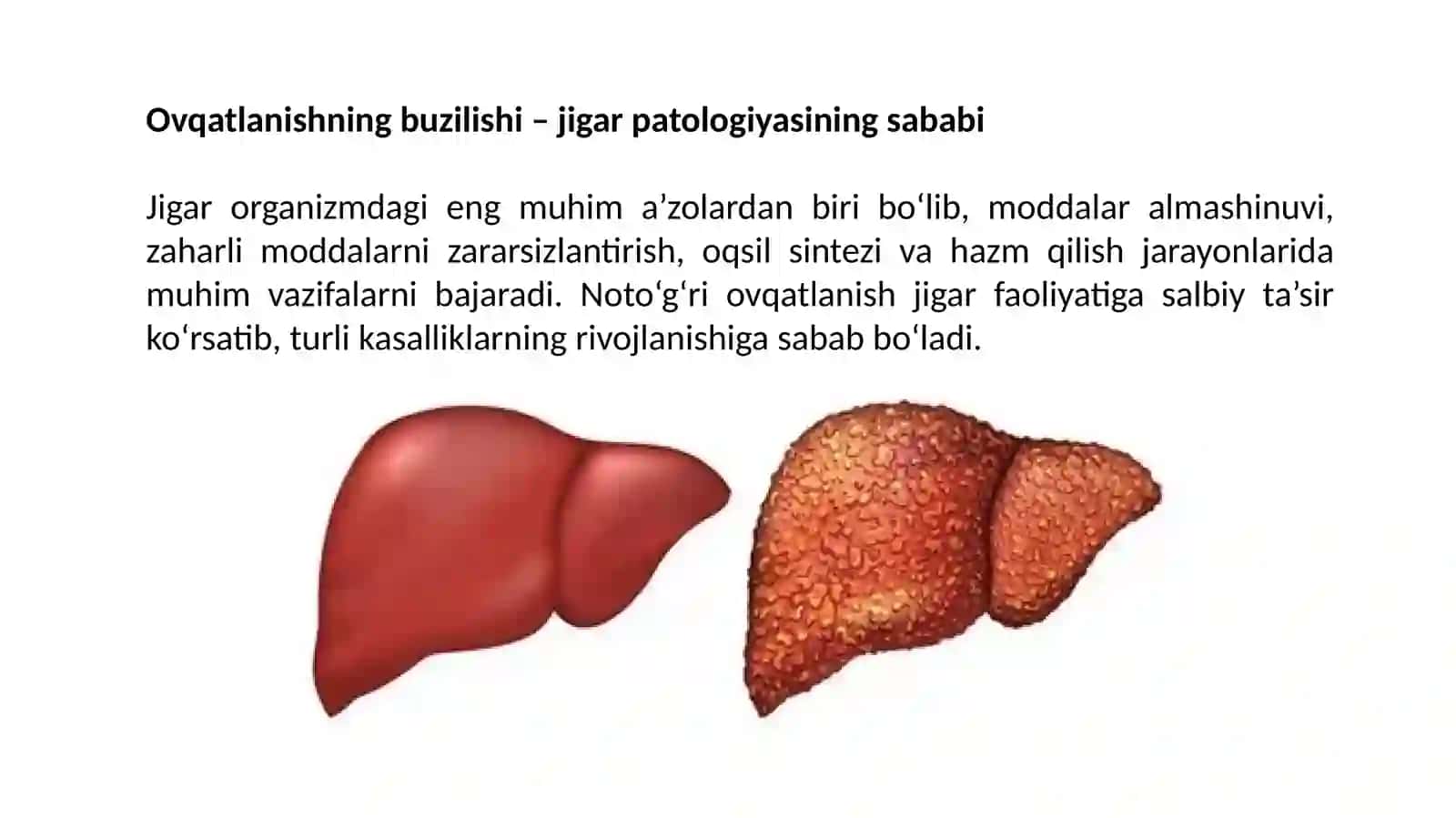 OVQATLANISHNING BUZILISHI – JIGAR PATOLOGIYASINING SABABI 3